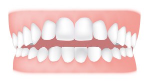 Open bite <br> An open bite is where the front teeth don’t overlap the lower teeth. An open bite affecting the front teeth is known as an anterior open bite.